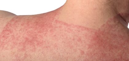 Allergic Reaction Causing Contact Dermatitis