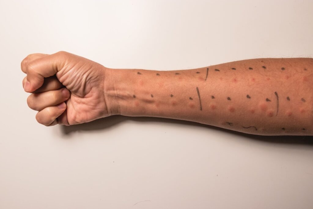 Allergy skin prick test results showing reactions on forearm